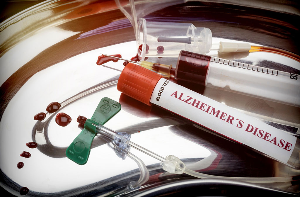 Image: A simple test can help predict risk of Alzheimer\'s disease 20 years in advance (Photo courtesy of 123RF)