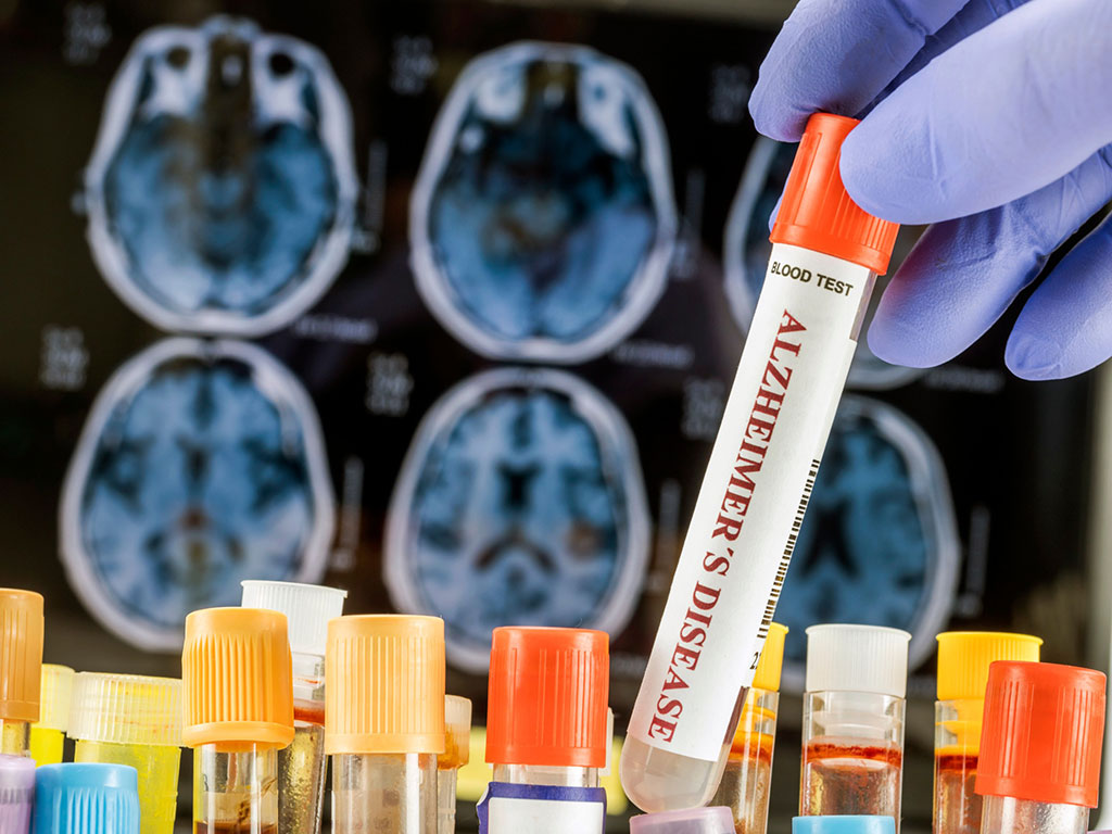 Image: A blood biomarker can predict progression to Alzheimer’s disease in at-risk population (Photo courtesy of 123RF)