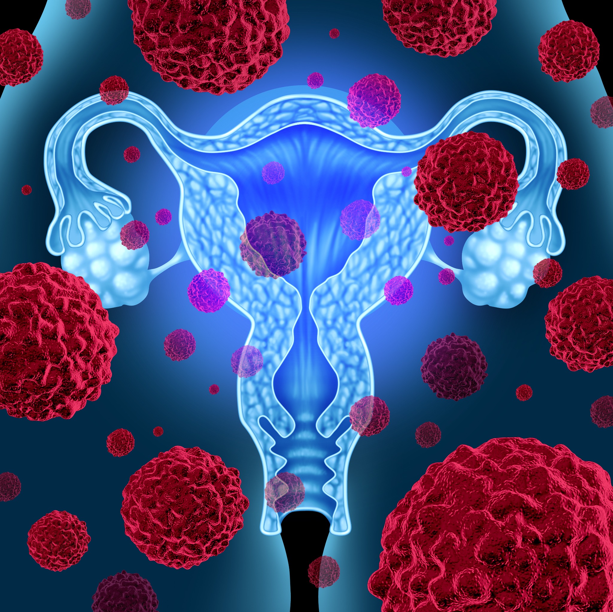 Image: The epiCervix test can detect cervical cancer at its earliest stages by looking at changes in four specific genes (Photo courtesy of 123RF)