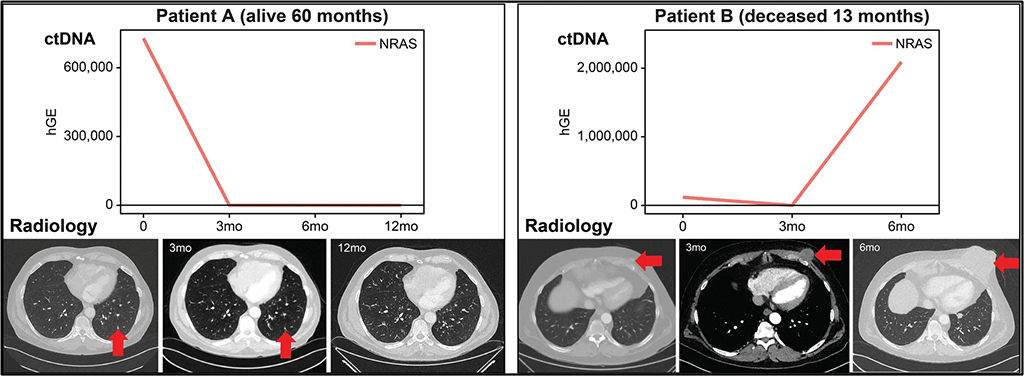 Image: Circulating tumor DNA correlates with radiology disease assessment and patient outcome (Photo courtesy of The Journal of Molecular Diagnostics)