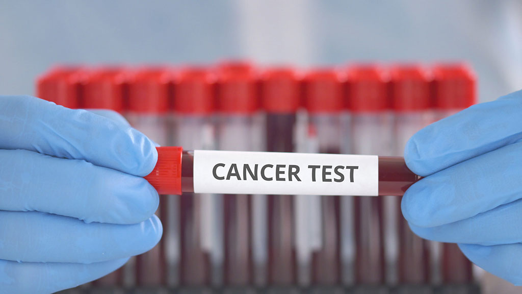 Image: An investigational blood test might one day help doctors detect pancreatic cancer earlier (Photo courtesy of 123RF)