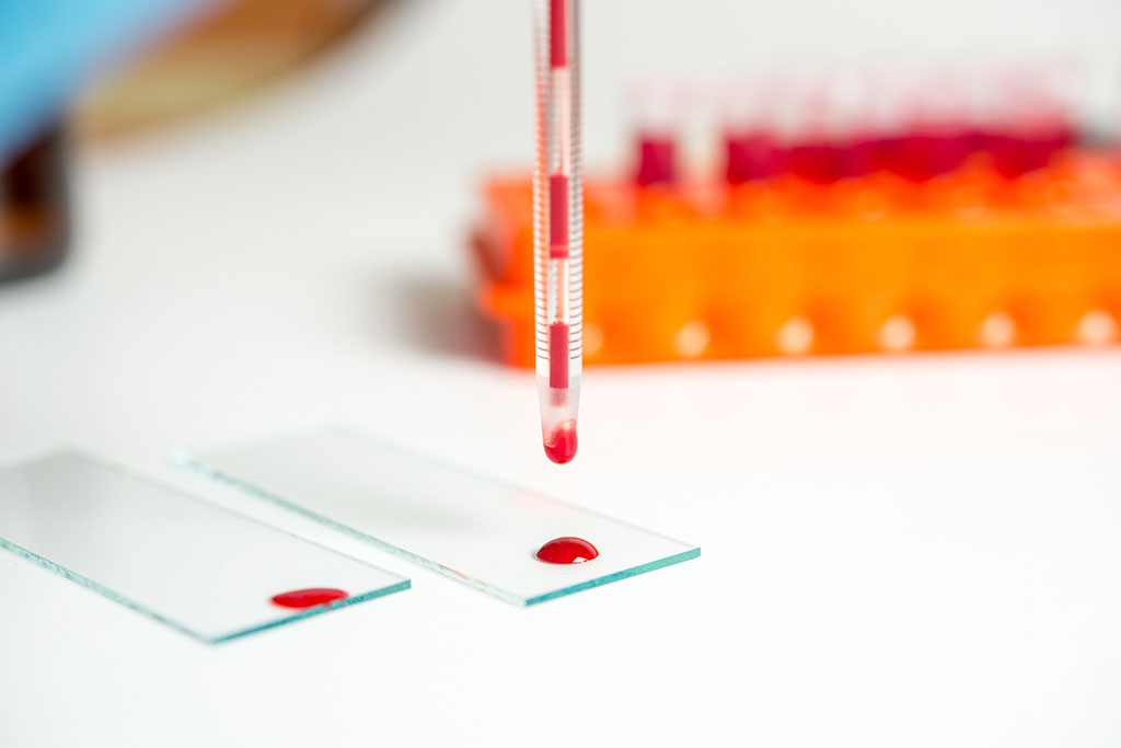 Image: The blood test offers a new way of improving diagnosis of bipolar disorder (Photo courtesy of 123RF)