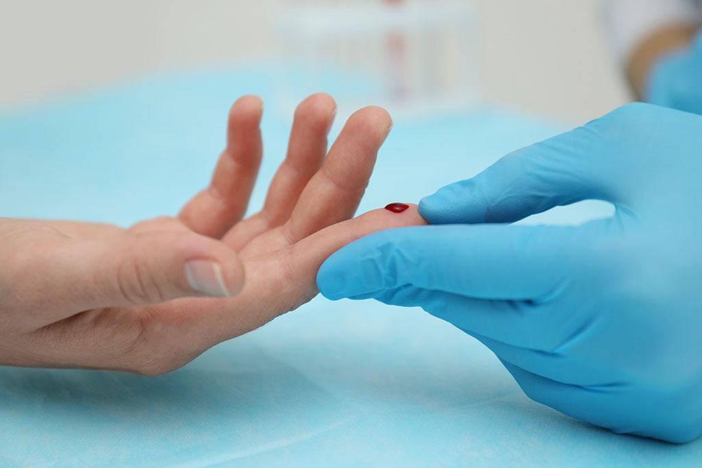 Image: A rapid new analytical tool for diagnosing tuberculosis needs just a bloodsample from the fingertip (Photo courtesy of 123RF)