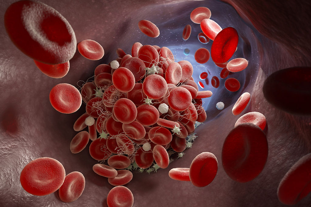 Графическое изображение показывает сгусток крови,образующийся в артерии