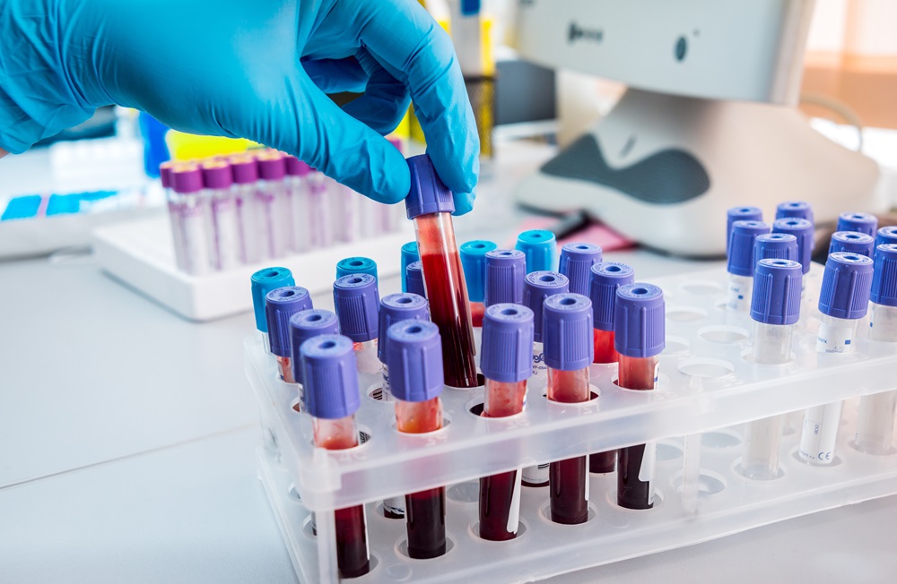 Image: A newly identified biomarker could lead to a simple blood test for a rare autoimmune disease (Photo courtesy of Shutterstock)