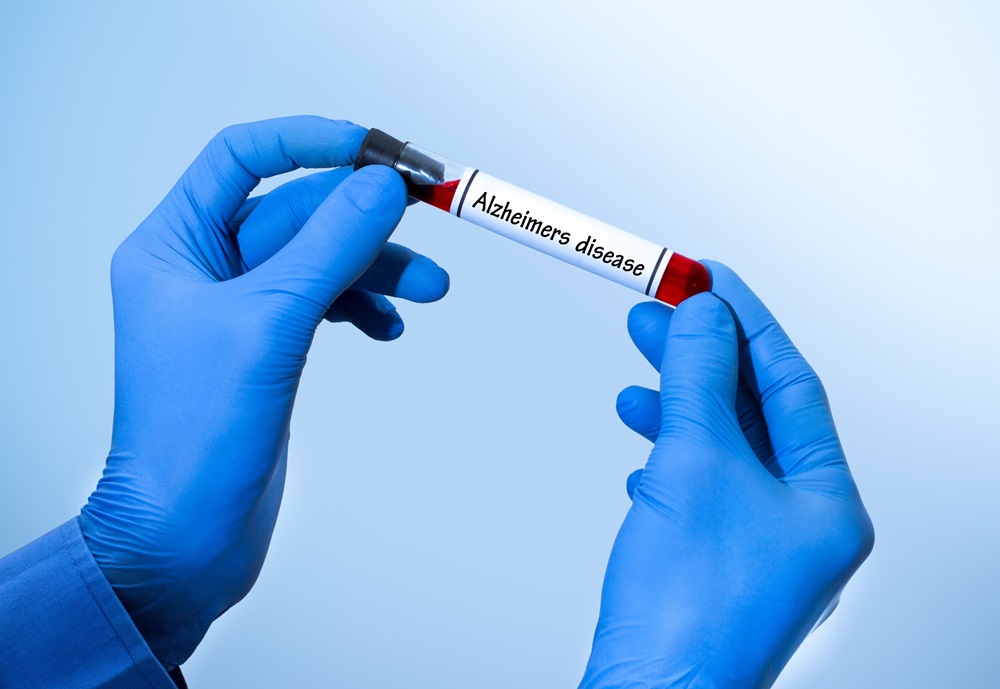 Image: Detecting Alzheimer’s disease using a blood test could be just as accurate as standard lumbar punctures (Photo courtesy of 123RF)