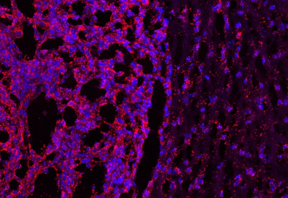 Image: Glioblastoma cells (Photo courtesy of Imperial College London)
