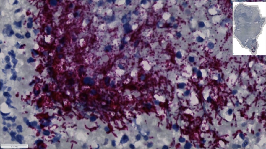 Image: Microscope image showing human colorectal cancer tumor with Fusobacterium nucleatum stained in a red-purple color (Photo courtesy of Fred Hutch Cancer Center)