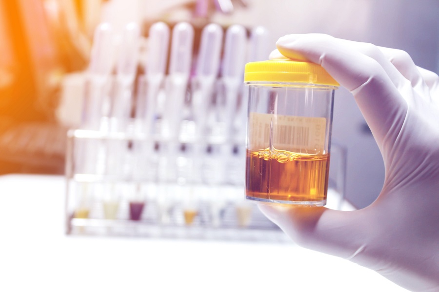 Image: The test can detect tumor DNA fragments in urine samples (Photo courtesy of 123RF)