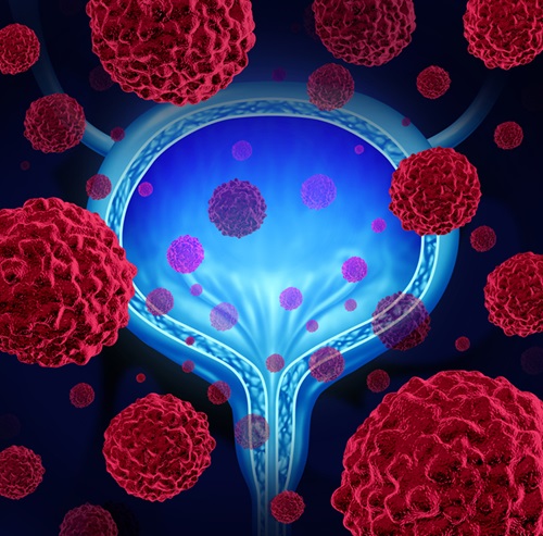 Image: AssureMDx is a noninvasive, urine-based test for the early detection of bladder cancer (Photo courtesy of Lightspring/Shutterstock)