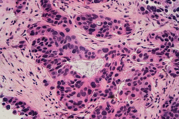 Image: The new AI system can help with breast cancer diagnoses (Photo courtesy of David Litman/Shutterstock)