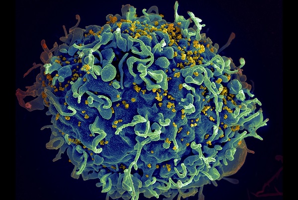 Image: HIV particles, tiny yellow spheres, are attacking a CD4+ T cell shown in blue (Photo courtesy of Seth Pincus, Elizabeth Fischer and Austin Athman/NIH)