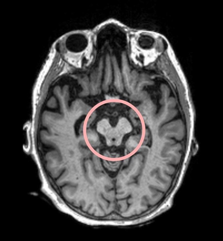 Image: A brain scan showing the presence of progressive supranuclear palsy in the area circled in red (Photo courtesy of UCSF)