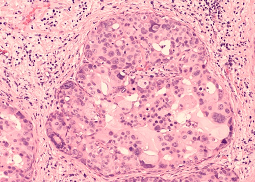 Image: The AI model can distinguish different stages of DCIS from inexpensive and readily available breast tissue images (Photo courtesy of David A. Litman/Shutterstock)
