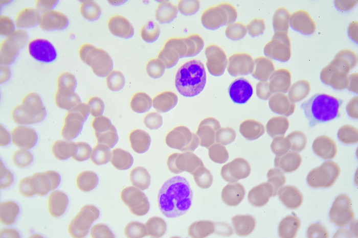 Image: The blood test measures lymphocytes  to guide the use of multiple myeloma immunotherapy (Photo courtesy of 123RF)
