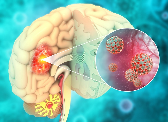 Image: A blood-based assay has been developed for the detection of IDH1.R132H-mutant gliomas (Photo courtesy of 123RF)