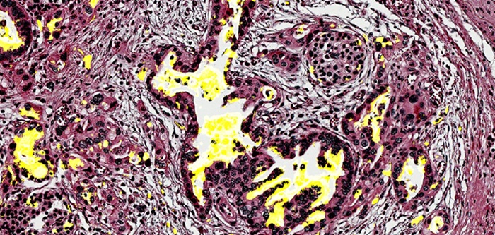 Image: Pancreatic tissue with the biomarker CA199.STRA in yellow (Photo courtesy of Haab Lab/Van Andel Institute)