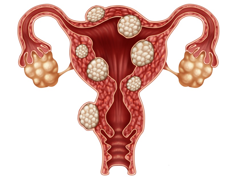 Image: New research promises a potential non-invasive stool test and novel therapy for endometriosis (Photo courtesy of Shutterstock)