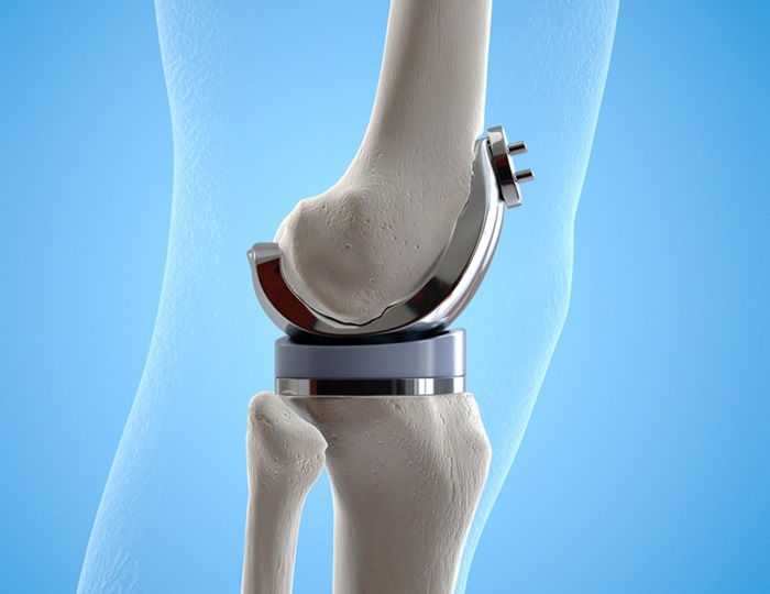 Image: The InfectoSynovia test has the potential to revolutionize the diagnosis of periprosthetic joint infection (Photo courtesy of 123RF)