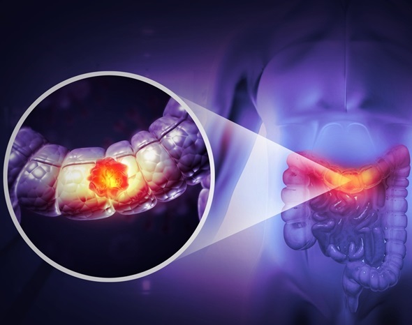 Image: The bowel cancer breakthrough could result in better treatment outcomes (Photo courtesy of Shutterstock)