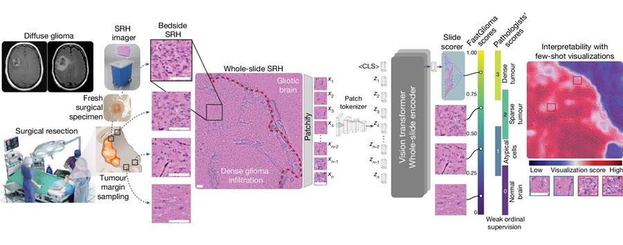 Image: FastGlioma workflow (Photo courtesy of Nature 2024, DOI: https://doi.org/10.1038/s41586-024-08169-3)