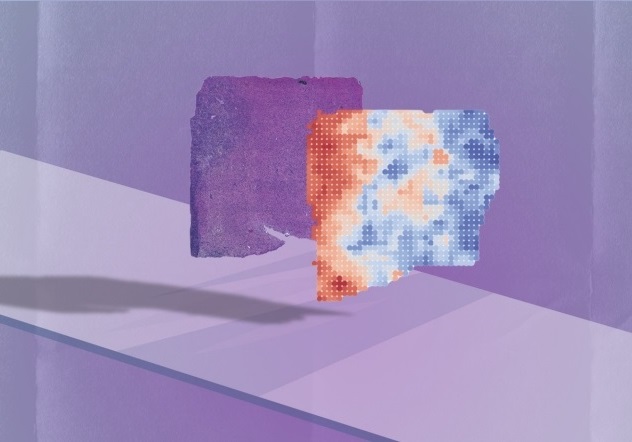 Image: The AI program analyzes a microscopy image from a tumor biopsy and determines what genes are likely turned on and off in the cells it contains (Photo courtesy of Olivier Gevaert/Stanford Medicine)