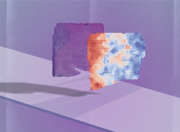 Image: The AI program analyzes a microscopy image from a tumor biopsy and determines what genes are likely turned on and off in the cells it contains (Photo courtesy of Olivier Gevaert/Stanford Medicine)