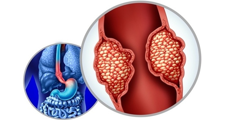 Image: The study aimed to understand why some cases of Barrett’s esophagus progress to cancer while others do not (photo courtesy of Shutterstock)