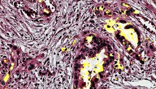 Image: Pancreatic tissue with the biomarker CA199.STRA in yellow (Photo courtesy of the Haab Lab, Van Andel Institute)