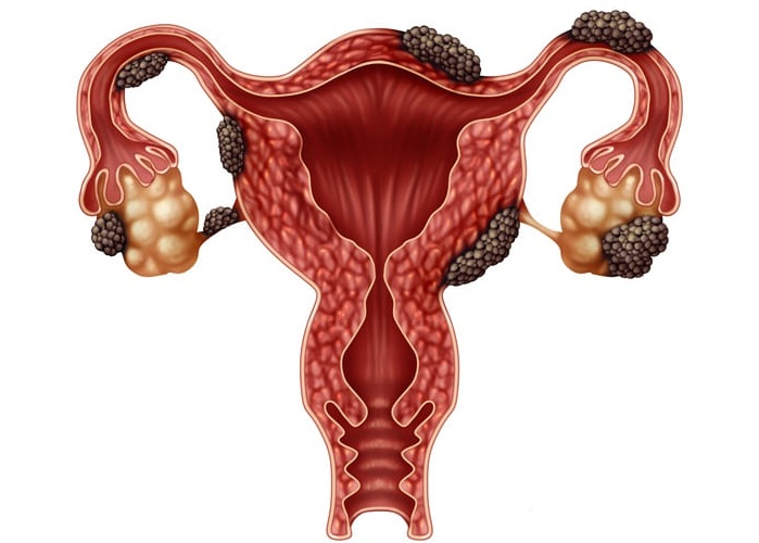 Image: The plasma protein biomarker panel identifies all stages of endometriosis with high accuracy (Photo courtesy of Adobe Stock)