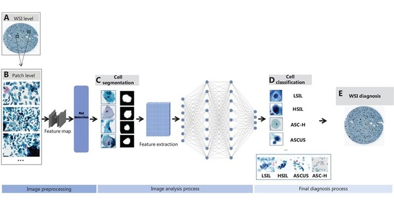 Image: Schematic representation of AI-assisted cervical cytology image analysis (Photo courtesy of Cancer Biology & Medicine, DOI:10.20892/j.issn.2095-3941.2024.0198)