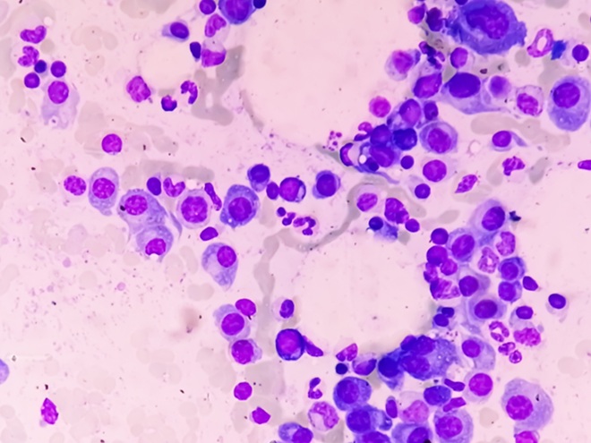 Image: The plasma cell dataset was created to assist in the accurate diagnosis (Photo courtesy of Shutterstock)