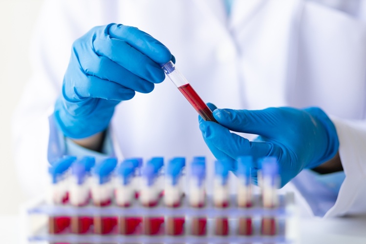 Image: The research paves the way for the development of blood tests to detect disease-specific biomarkers (Photo courtesy of 123RF)