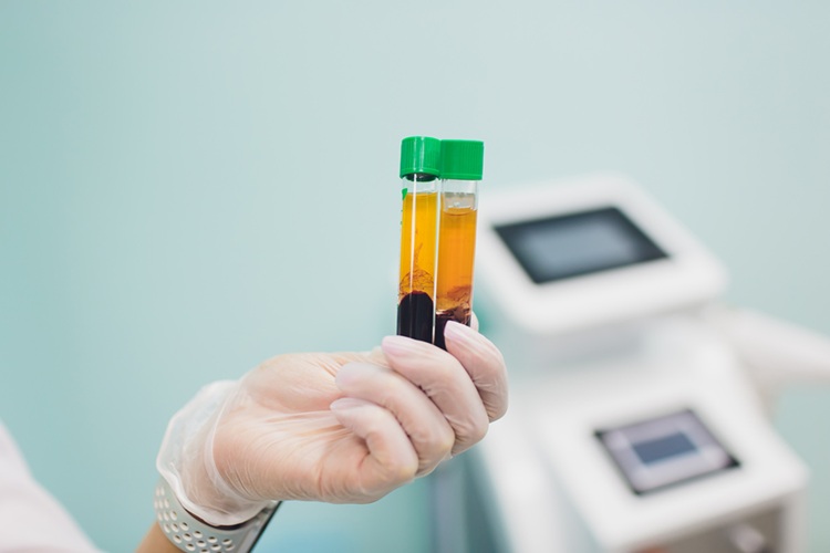 Image: The blood test uses lipids to identify children who are more susceptible to obesity-related problems (Photo courtesy of 123RF)