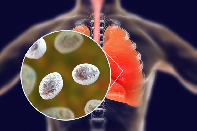 Image: The highly accurate test detects RNA from live fungi in blood samples and throat swabs (Photo courtesy of 123RF)