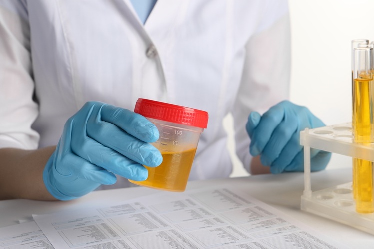 Image: Prostate cancer can be diagnosed at an early stage through a simple urine sample (Photo courtesy of Shutterstock)