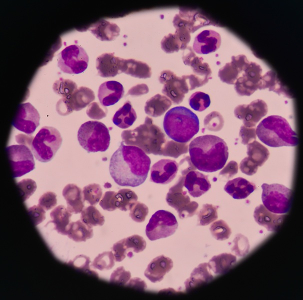 Image: The AI model accurately classifies pediatric sarcomas using digital pathology images alone (Photo courtesy of 123RF)