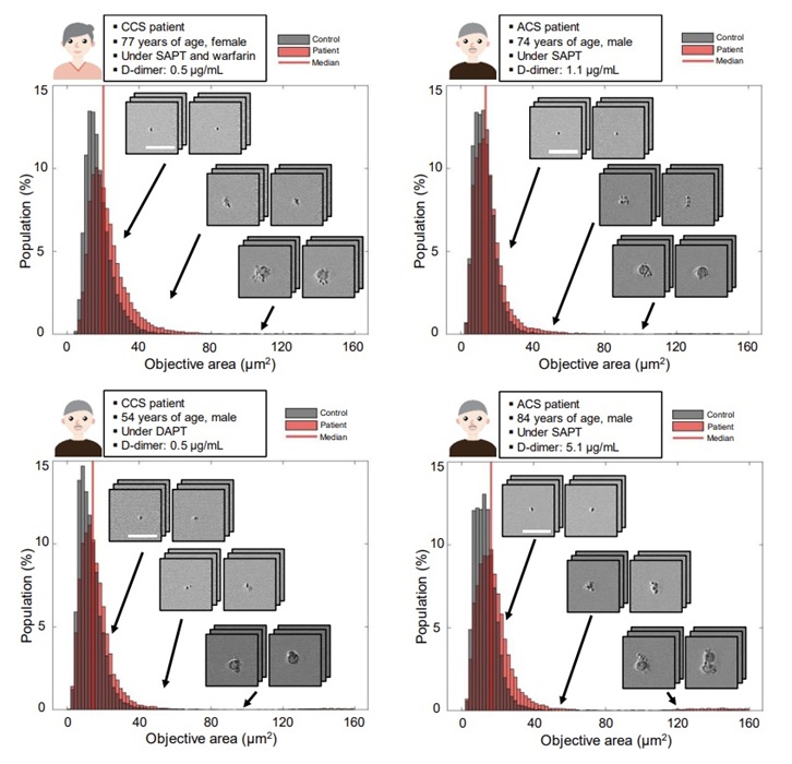 Image: AI-analyzed images from the FDM microscope show platelet clumps in motion (Photo courtesy of Hirose et al CC-BY-ND)