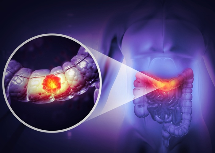 Image: A ctDNA blood test detected 79% of colorectal cancers in a screening study (Photo courtesy of Shutterstock)