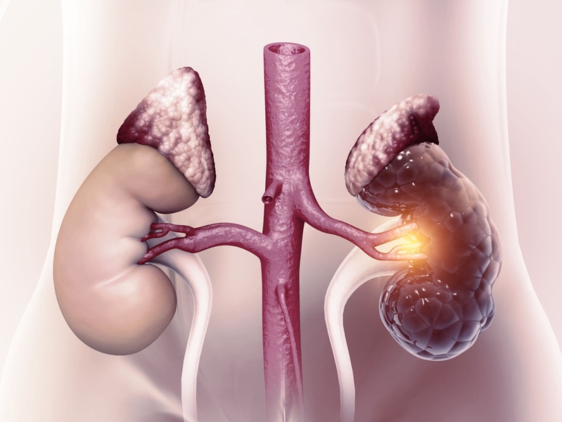 Image: A new biomarker panel can significantly improve the prediction of CKD progression (Photo courtesy of Adobe Stock)