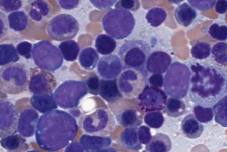 Image: The AI tool helps to automate the counting of different blood cell types contained in a blood or bone marrow sample (Photo courtesy of MSK)