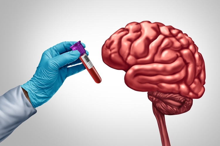 Image: The TyG index could help predict the pace of cognitive decline after diagnosis of Alzheimer’s (Photo courtesy of 123RF)