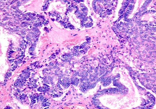 Image: The cancer stem cell test can accurately choose more effective treatments (Photo courtesy of University of Cincinnati)
