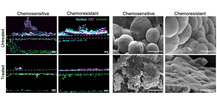 Image: These images illustrate how precision oncology Organ Chips recapitulate individual patients’ responses to chemotherapy (Photo courtesy of Wyss Institute)