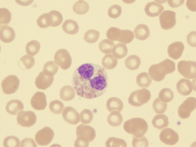 Image: A simple blood test can assess a person’s risk of developing blood cancer (Photo courtesy of Shutterstock)