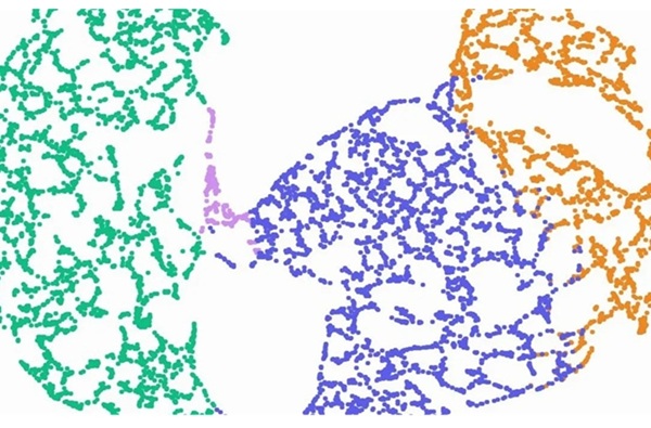 Image: The RNA-seq based diagnostic test for pediatric leukemia ensures better outcomes for children with this common cancer (Photo courtesy of Qlucore)