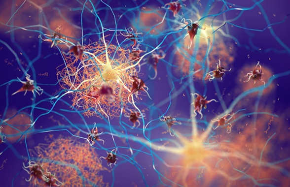 Image: The plasma biomarker p-tau217, obtained through a blood test, can predict the clinical progression of Alzheimer’s (Courtesy of Adobe Stock)