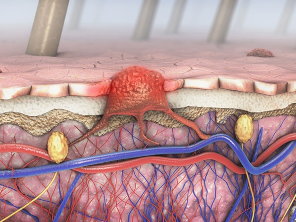 Image: The AI-based tool quantifies tumor-infiltrating lymphocytes in tissue samples with greater consistency and accuracy (Courtesy of Adobe Stock)