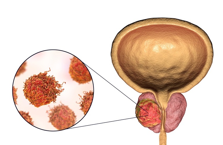 Image: A new study has shed light on why some prostate tumors are resistant to treatment (Photo courtesy of Adobe Stock)