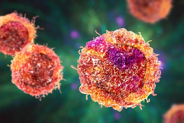 Image: An “evolutionary” approach to treating metastatic breast cancer could allow therapy choices to be adapted as patients’ cancer changes (Photo courtesy of 123RF)
